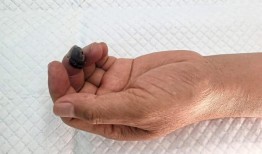 你听说过心脏搭桥手术，但你听说过手臂搭桥手术吗？