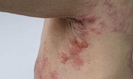 更多的澳大利亚人将能够获得免费的带状疱疹疫苗