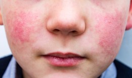 美国疾病控制与预防中心表示，美国细小病毒病例正在上升